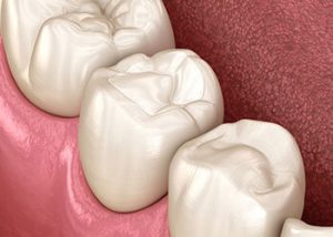 factors how long do tooth fillings last west ryde
